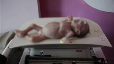  الأمم المتحدة تحث العالم على عدم نسيان 19 مليون جائع