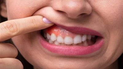 آفات وأعراض في الفم تكشف عن حالات خطيرة تؤثر على الجسم ككل