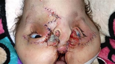 مستشفي سوهاج الجامعي يجري عملية جراحية لحالة نادرة لطفلة من دولة اليمن الشقيقة 