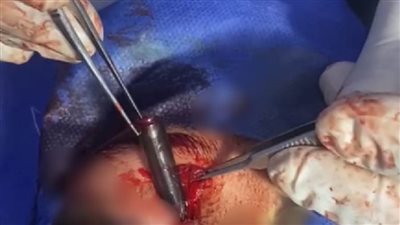 بعد أكثر من شهرين.. استخراج قلم جاف من تجويف عين طفل بالشرقية.. توقع أهله أنها كدمة