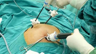 دراسة: تأخير التدخل الجراحي لاستئصال المرارة يزيد من المشاكل الصحية للمريض