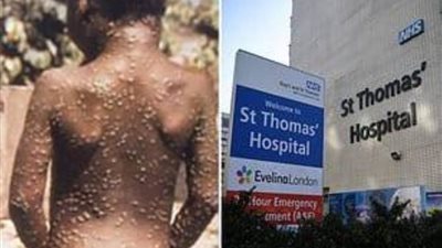 بريطانيا تعلن تسجيل إصابة بفيروس معد ونادر