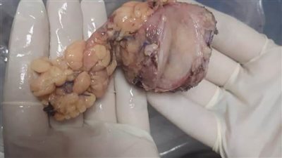 جراحة دقيقة بمركز أورام المنيا.. استئصال ورم سرطاني من بنكرياس مريض