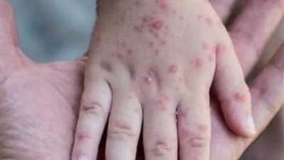 جدري القرود 