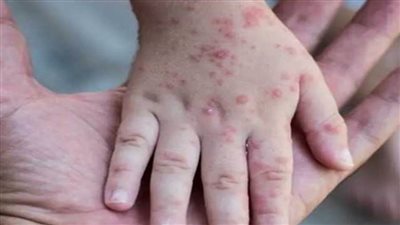 الصحة تصدر بيانا بشأن 