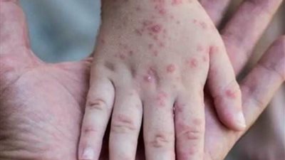 النمسا ترصد أول إصابة بفيروس جدري القردة