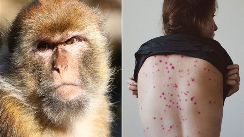 جدري القرود