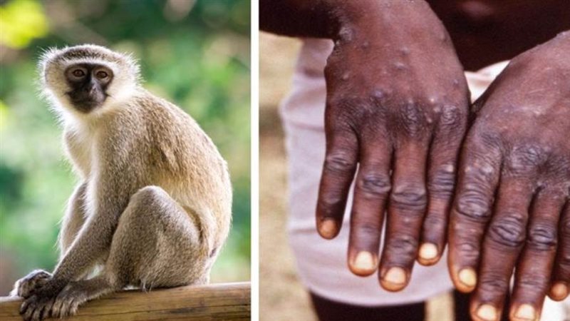 جدري القرود - ارشيفية