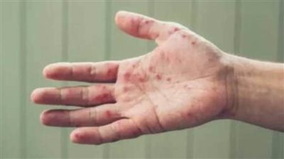 الأرجنتين تسجل أول إصابة بجدري القردة في أمريكا اللاتينية