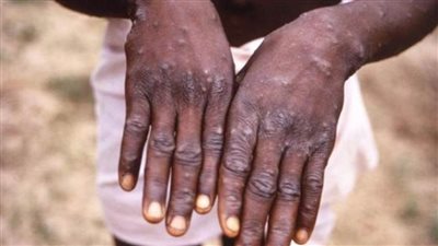 إيرلندا والمكسيك تؤكدان أولى حالات الإصابة بجدرى القرود