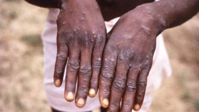 جدرى القرود