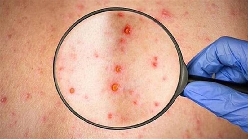 جدري القرود