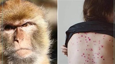 كيفية الوقاية من عدوي جدري القرود