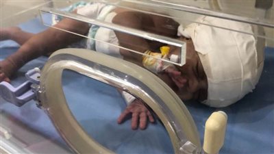 إجراء جراحة عاجلة ودقيقة بالمخ لطفلة بمركز إيواء العاشر 