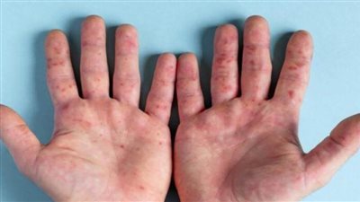 الإمارات تعلن تسجيل 5 حالات جديدة بجدري القردة وحالتي شفاء