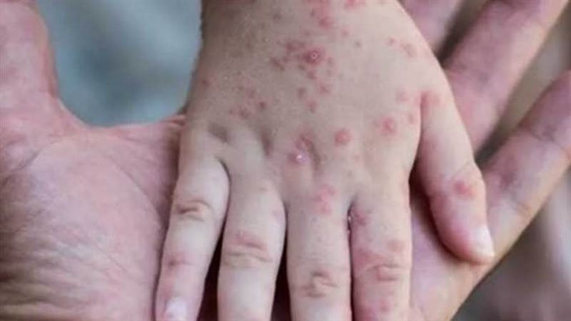 ارتفاع عدد الإصابات