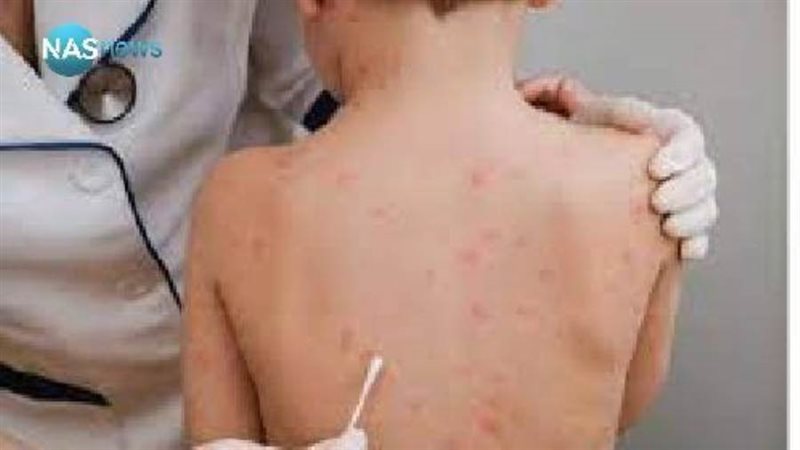 إصابة مؤكدة بجدري