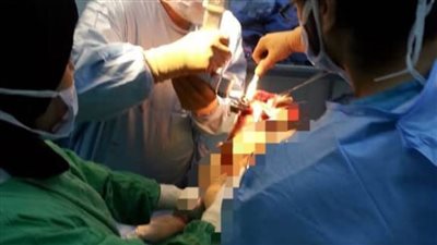 إجراء ١٠ عمليات بمستشفى رشيد ضمن المبادرة الرئاسية للقضاء على قوائم الانتظار