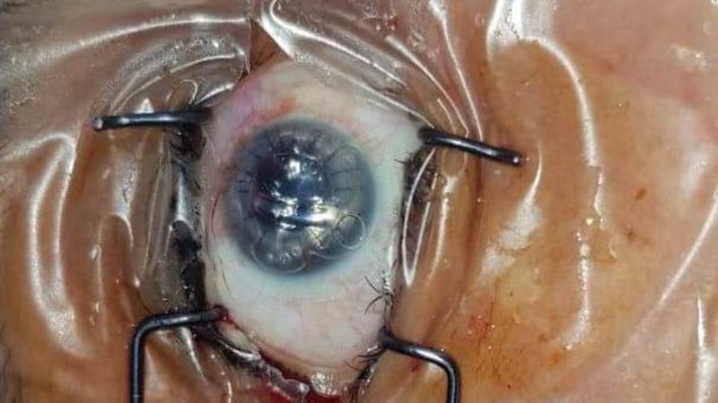 زراعة قرنية برمد