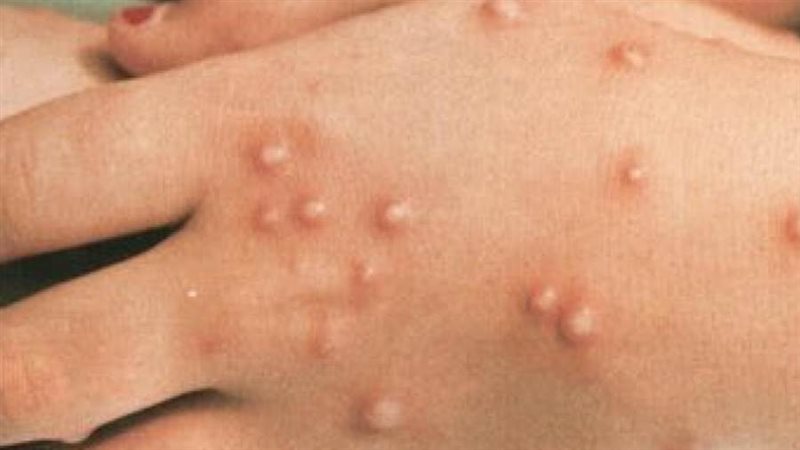 جدري القرود