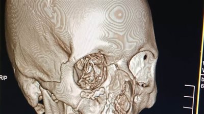 إجراء جراحة لتثبيت كسر بالوجه بشرائح ومسامير لمريض بمستشفى أبو المطامير بالبحيرة