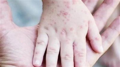 الإعلان عن أول حالة إصابة بفيروس 