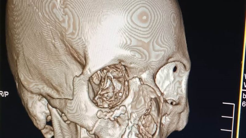 إجراء جراحة لتثبيت