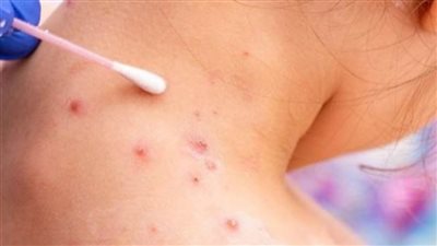 سنغافورة تسجل ثالث حالة إصابة محلية مؤكدة بفيروس جدري القردة