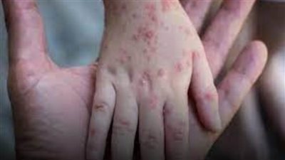 ارتفاع الإصابات بجدري القرود في الممكلة المتحدة إلى 1856 حالة