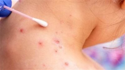 الإمارات تعلن تسجيل 3 حالات لجدري القردة