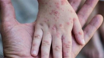 تسجيل أول إصابة مؤكدة بجدري القردة في اليابان  لشخص قادم من أوروبا