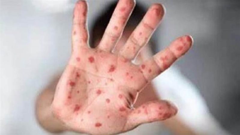 مؤكدة بجدري القردة