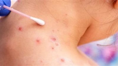 الصحة الفلبينية تكشف عن أول إصابة بفيروس جدري القردة