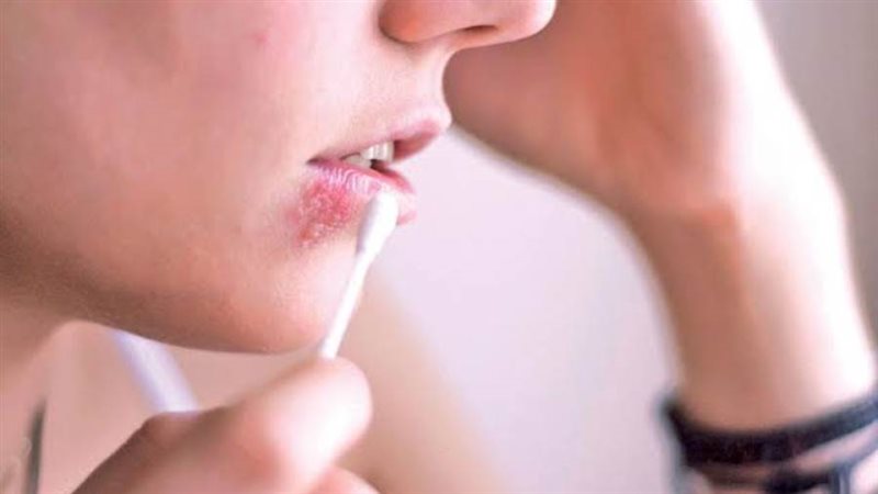 فيروس الهربس قد يسبب