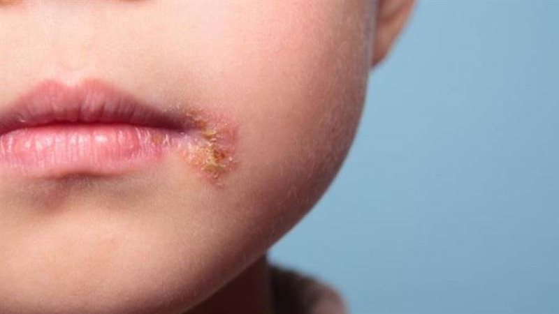 فيروس الهربس الفموي