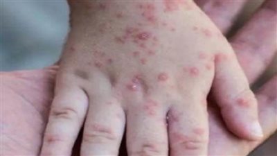 ارتفاع إصابات جدري القردة في الولايات المتحدة إلى 13 ألفًا و517 حالة