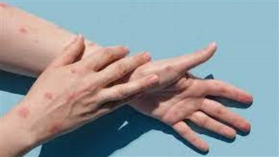 ارتفاع إصابات جدري القردة في الولايات المتحدة لأكثر من 14 ألف حالة