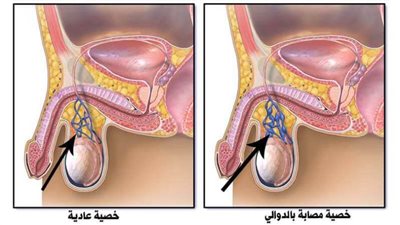 تعرف على علاج دوالي الخصية.. المرض الذي يصيب 20% من الرجال 