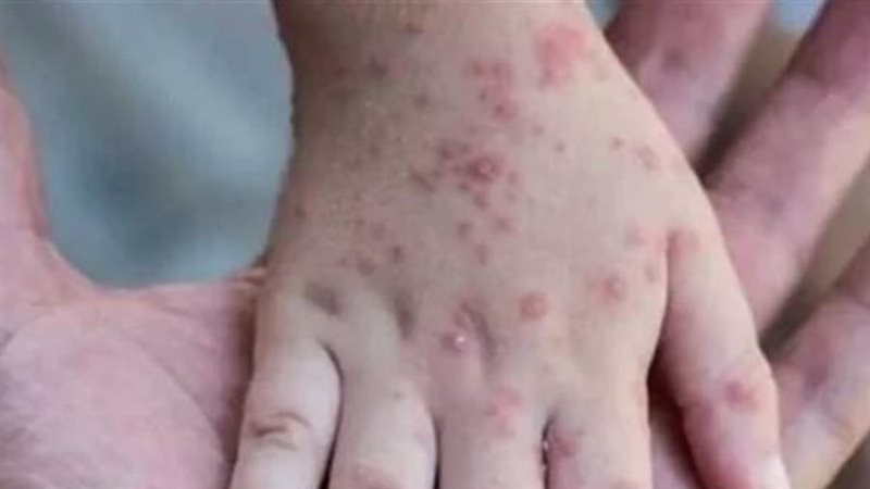 فيروس جدري القردة