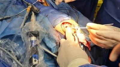 رئيس جامعة بني سويف: إجراء أول حالة إزالة ورم عن طريق منظار المخ