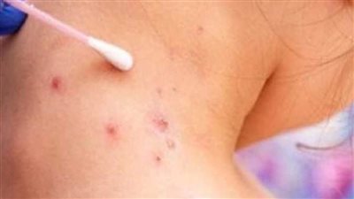 تسجيل أول حالة وفاة في الولايات المتحدة لشخص مصاب بجدري القرود