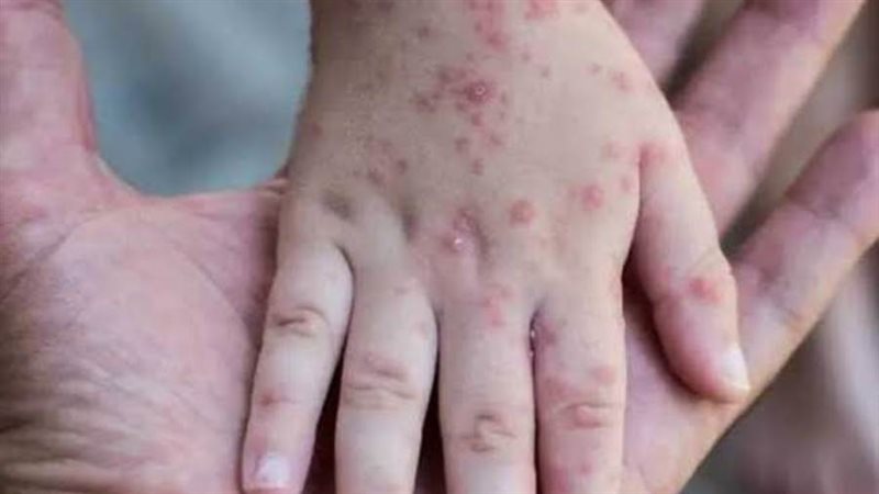 جدري القرود