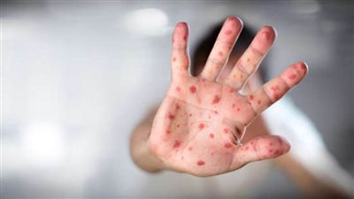 عقار روسي جديد لعلاج جدري القردة