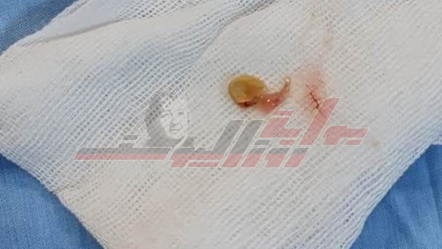 العملية التي أنقذت رضيعا