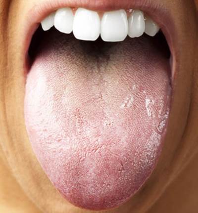 اللسان يمكن أن يكشف عن نقص معدن هام في الجسم