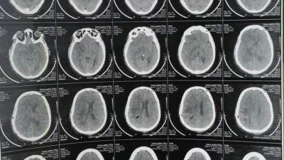 نجاح جراحة ميكروسكوبية دقيقة لاستئصال ورم بالمخ بمستشفى سوهاج الجامعي